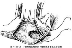 房間隔缺損手術注意事項