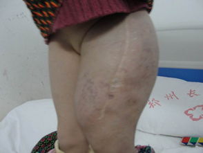 肝部海綿狀血管瘤注意事項,顱內(nèi)海綿狀血管瘤注意事項,海綿狀血管瘤術(shù)后注意事項