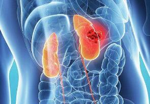 腎癌術(shù)前注意事項(xiàng)
