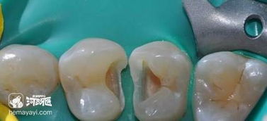 寶寶補(bǔ)牙后注意事項(xiàng)