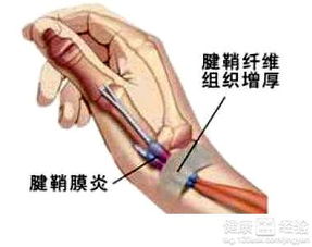 腱鞘炎打針后注意事項(xiàng)