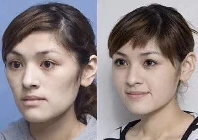 肌注,尿酸,事項,蘋果