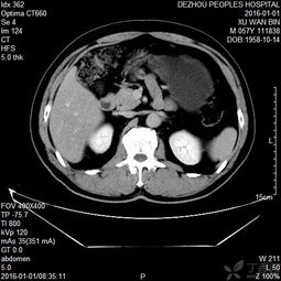 胰腺查血注意事項(xiàng)