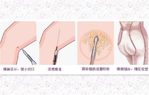 大腿環(huán)吸術(shù)后注意事項(xiàng)