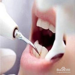 哪家,注意事項,洗牙