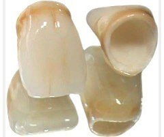 全瓷冠修復的注意事項