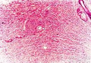 注意事項,纖維瘤