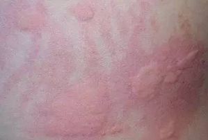 冷激性蕁麻疹注意事項(xiàng)