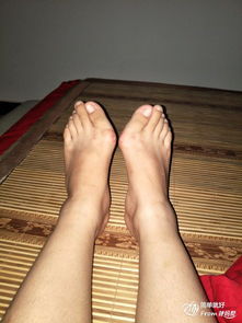 做完拇指外翻手術(shù)后應(yīng)注意事項