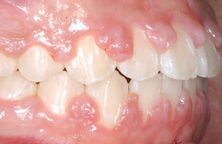 補(bǔ)牙戴牙套后注意事項(xiàng),補(bǔ)牙后裝牙套后有什么注意事項(xiàng),補(bǔ)牙后的注意事項(xiàng)