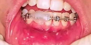 戴牙套第一周注意事項