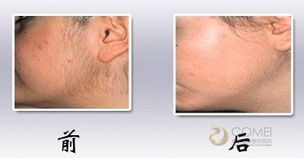 激光,注意事項(xiàng),脫臉毛后