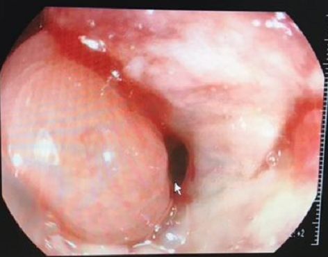 直腸支架注意事項