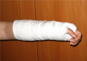 骨折打了石膏注意事項