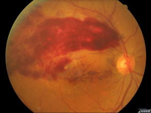 做眼底檢查時(shí)病人注意事項(xiàng)