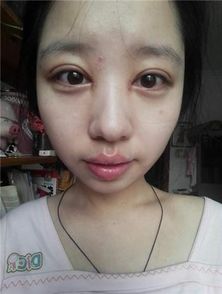 全切雙眼皮第一天注意事項