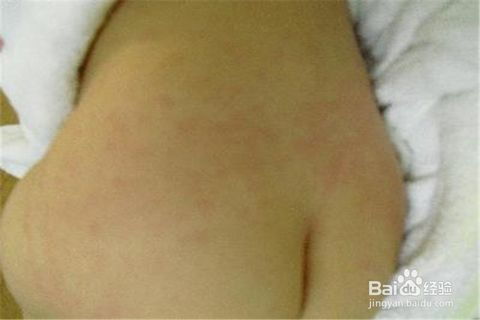 退燒后出疹子注意事項,寶寶出疹子注意事項,發(fā)燒出疹子注意事項