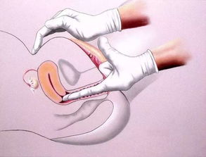 盆腔,注意事項(xiàng),月經(jīng)期,檢查