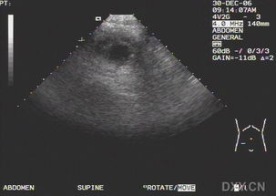 闌尾腫大要注意事項(xiàng)