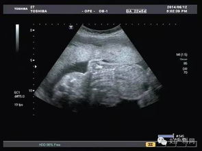 超聲,孕婦,注意事項(xiàng),檢查