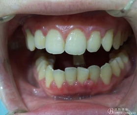 牙周病例書寫注意事項(xiàng)