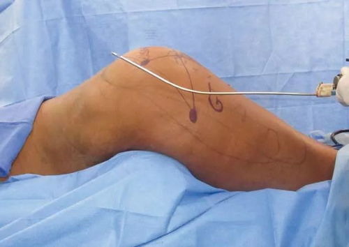 移植前的注意事項(xiàng),移植后的注意事項(xiàng),移植后注意事項(xiàng)和飲食