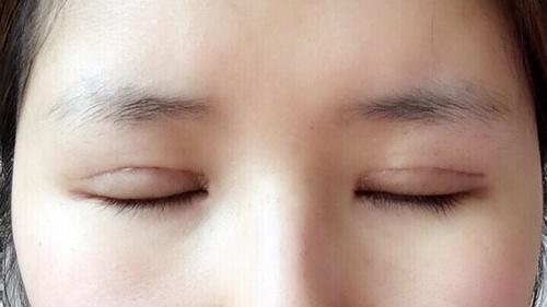 雙眼皮,注意事項