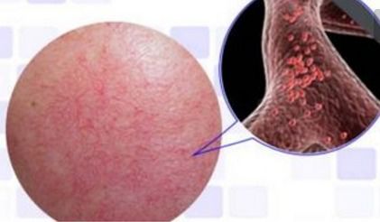 疣做了激光后注意事項,做了刺絡(luò)的注意事項,做激光以后注意事項