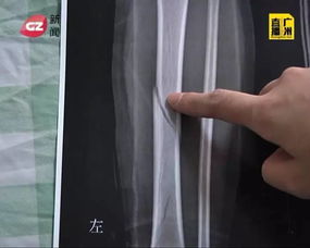 腳趾,骨折,注意事項,兒童