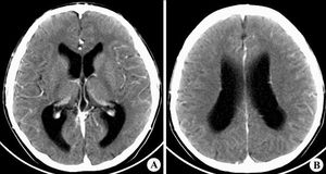 腦水腫飲食的注意事項(xiàng),腦水腫脫水治療時(shí)的注意事項(xiàng)是,腦水腫期注意事項(xiàng)