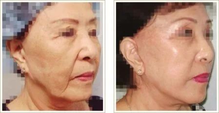 頭顱手術(shù)術(shù)后注意事項(xiàng)