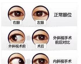 小兒斜視手術(shù)后注意事項,斜視矯正術(shù)后注意事項,間歇性斜視術(shù)后注意事項