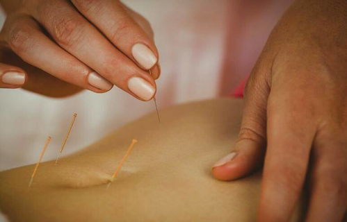 針灸肚子需要注意事項