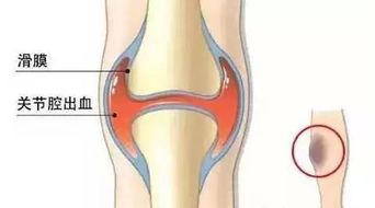 血友病人注意事項