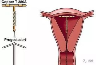 上完避孕環(huán)注意事項