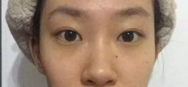 微整鼻子后的注意事項