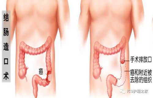 腸造瘺患者術(shù)后注意事項