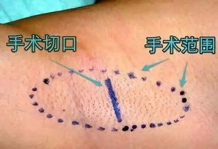 腋臭微創(chuàng)術(shù)后注意事項(xiàng)