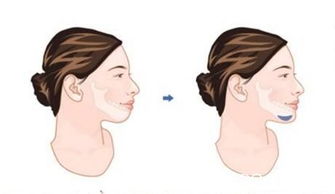 做下巴前注意事項