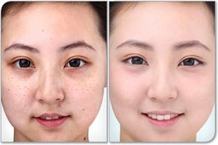 調(diào)q激光祛斑后注意事項