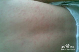 出了疹子后要注意事項