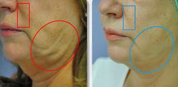 針灸埋線后的注意事項(xiàng),埋線減肥后注意事項(xiàng),埋線后注意事項(xiàng)有哪些