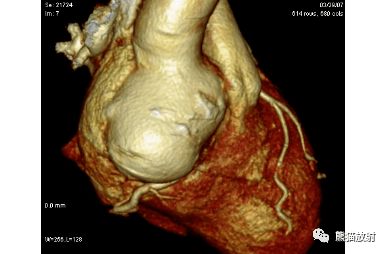 先天性主動脈鈣化飲食應(yīng)注意事項
