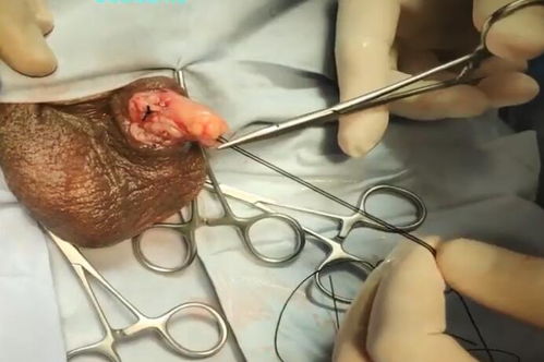 睪丸,切除,術(shù)前,注意事項(xiàng)