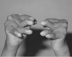 復(fù)發(fā)性風(fēng)濕癥注意事項