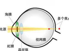 佩戴散光眼鏡注意事項(xiàng),兒童散光注意事項(xiàng),散光注意事項(xiàng)及飲食