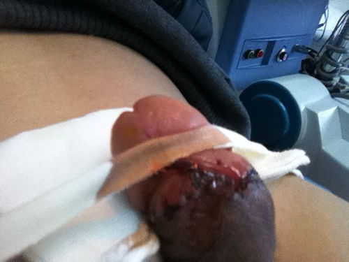 做完割脂肪瘤手術(shù)注意事項(xiàng)