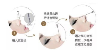 線雕鼻子后的注意事項(xiàng),線雕鼻子注意事項(xiàng)有哪些,鼻子做線雕的注意事項(xiàng)