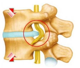 腰椎盤(pán)凸出注意事項(xiàng)