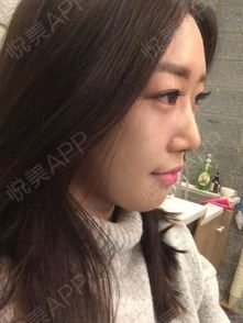 果酸,嫩膚,注意事項(xiàng)